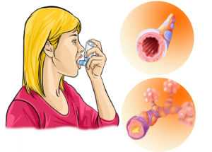 Дает ли астма инвалидность